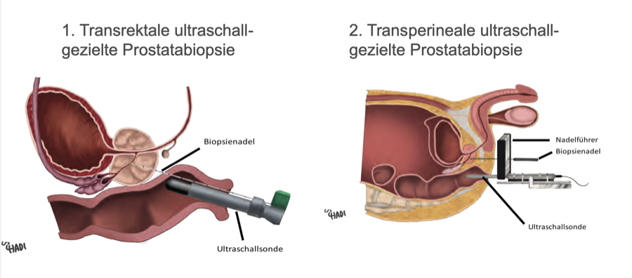 Diagnose durch Biopsie